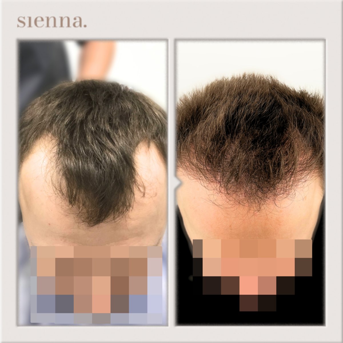 قبل وبعد زراعة الشعر في Sienna Clinic، استعادة خط الشعر وكثافة الشعر