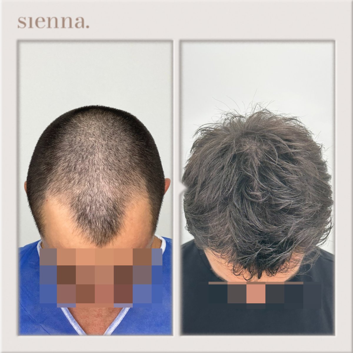 Résultat greffe de cheveux avant et après à Sienna Clinic – ligne capillaire restaurée