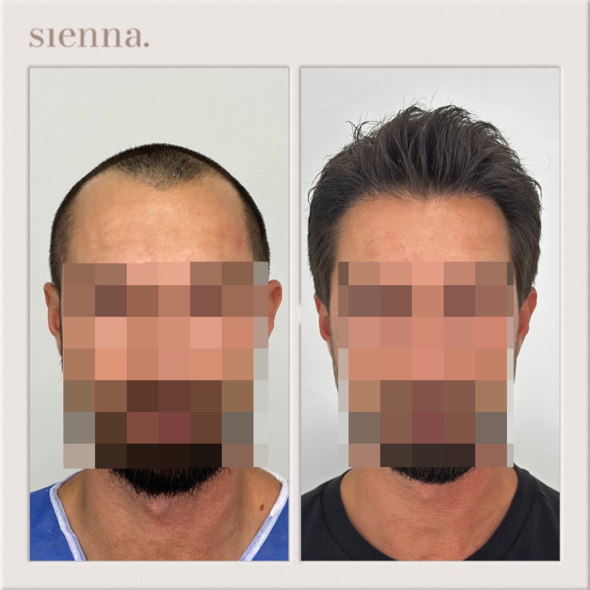 Vorher-nachher-Ergebnis Haartransplantation bei Sienna Clinic, natürliche Haarlinie
