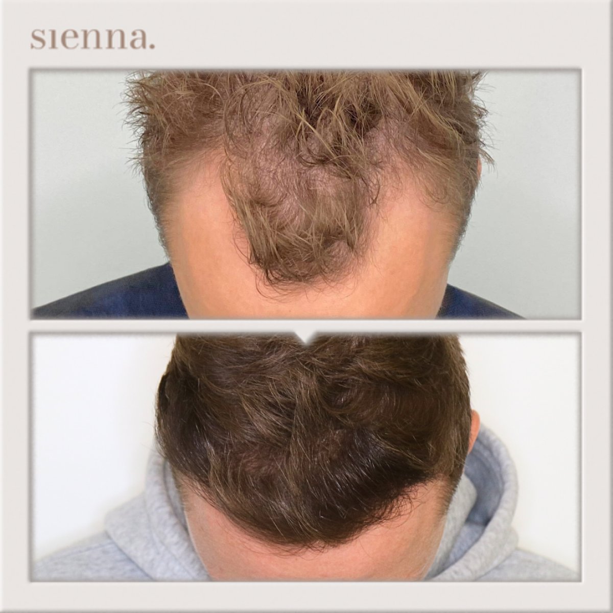 Before and after hair transplant results at Sienna Clinic – restored hairline and fuller hair
