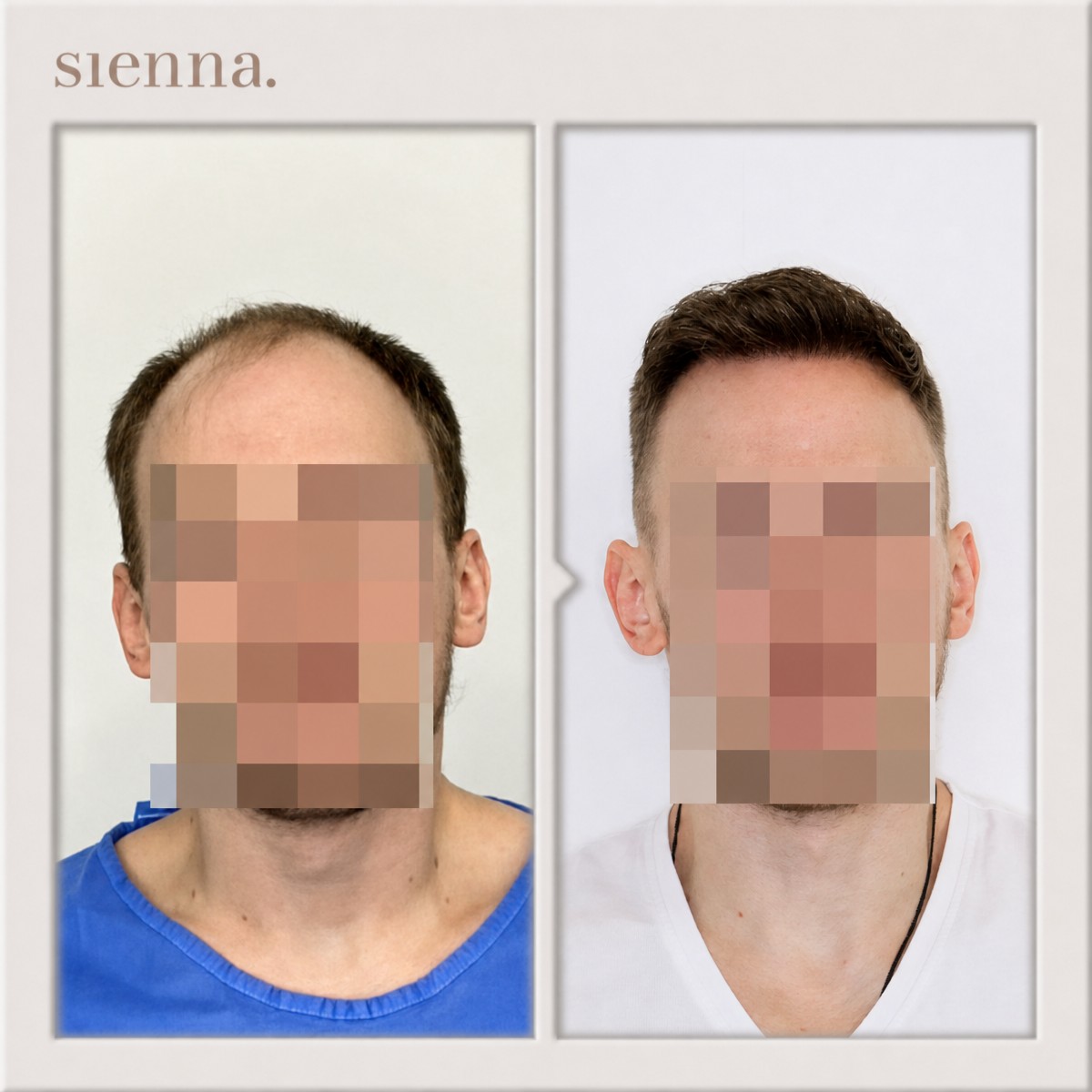 Before and after hair transplant result at Sienna Clinic, restored hairline in male patient