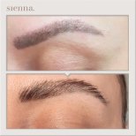 Hair transplant results by Dr. Antoni Krajewski - Patient’s before and after images Before and after Hair transplant photos by Dr. Antoni Krajewski