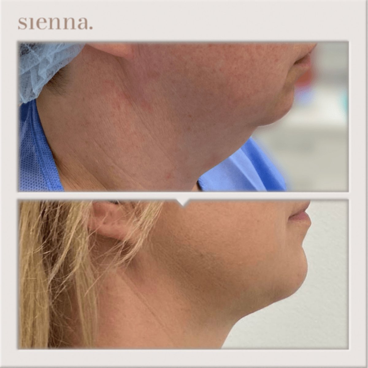 Before and after chin liposuction at Sienna Clinic – visible jawline contouring result