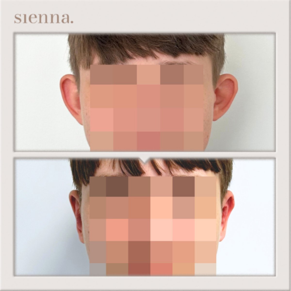 نتائج تجميل الأذن قبل وبعد في Sienna Clinic، تعديل الأذن بمظهر طبيعي