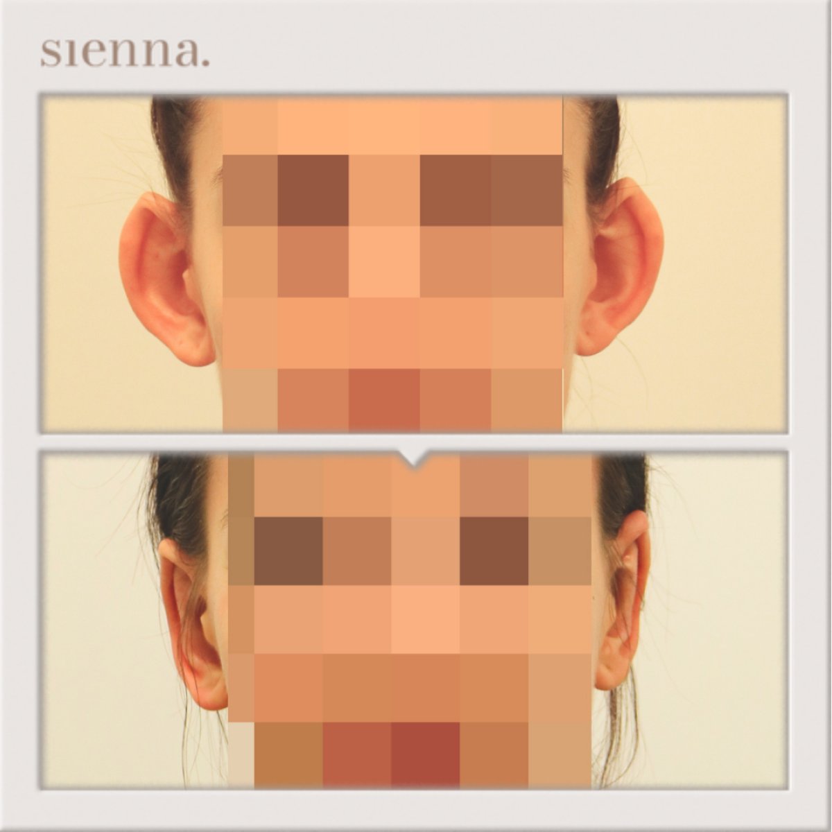 Resultados de otoplastia antes y después en Sienna Clinic, orejas de aspecto natural