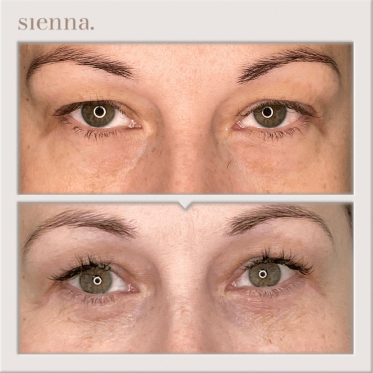 Результати блефаропластики до і після в Sienna Clinic, корекція повік для свіжого вигляду