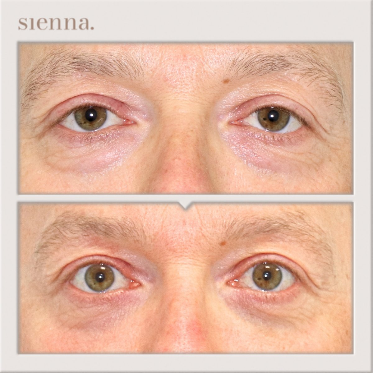 نتائج شد الجفون قبل وبعد في Sienna Clinic، تصحيح الجفون لمظهر أكثر انتعاشًا