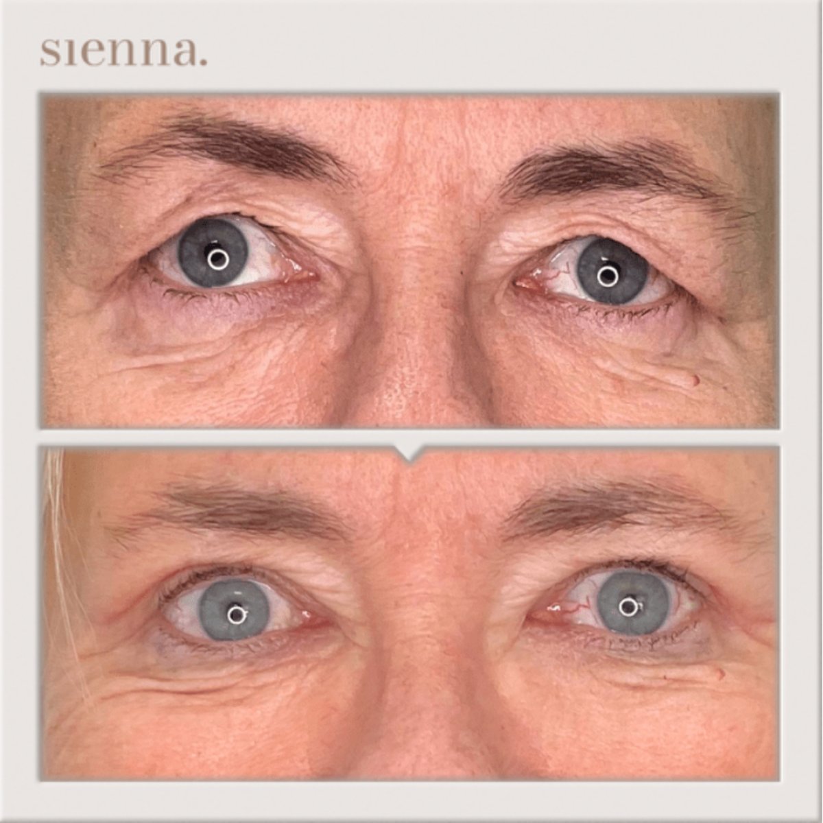 Before and after blepharoplasty results at Sienna Clinic – eyelid correction for youthful look