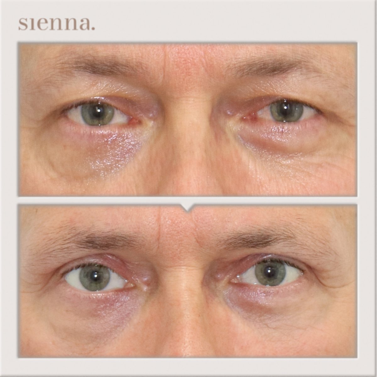 Before and after blepharoplasty results at Sienna Clinic, eyelid correction for refreshed look