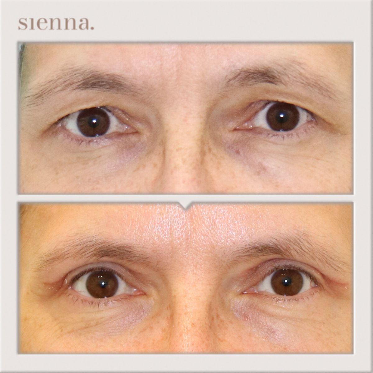 Before and after blepharoplasty results at Sienna Clinic, eyelid correction for refreshed look