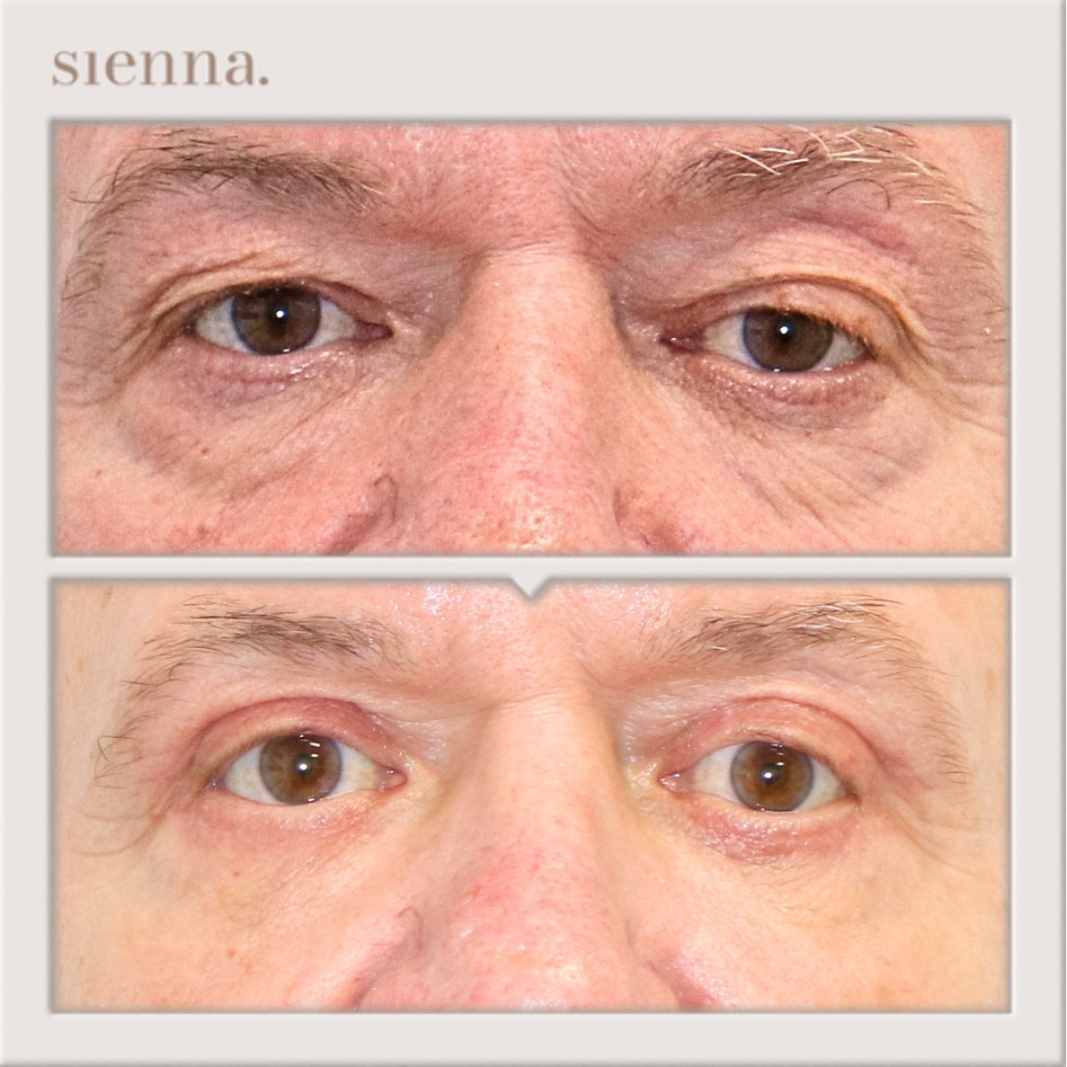 نتائج شد الجفون قبل وبعد في Sienna Clinic، تصحيح الجفن لمظهر أكثر شبابًا