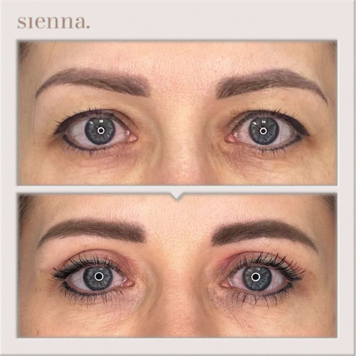 نتائج رأب الجفن قبل وبعد في Sienna Clinic، تصحيح الجفون لمظهر أكثر شبابًا