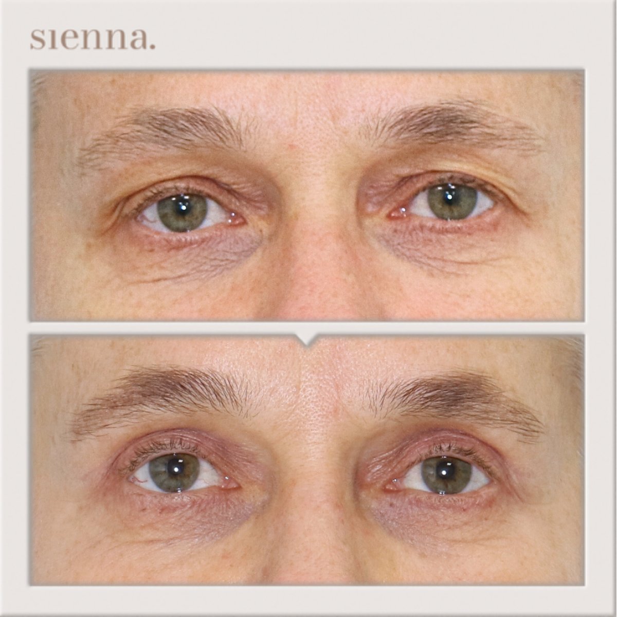 Resultados de blefaroplastia antes y después en Sienna Clinic, corrección de párpados masculina