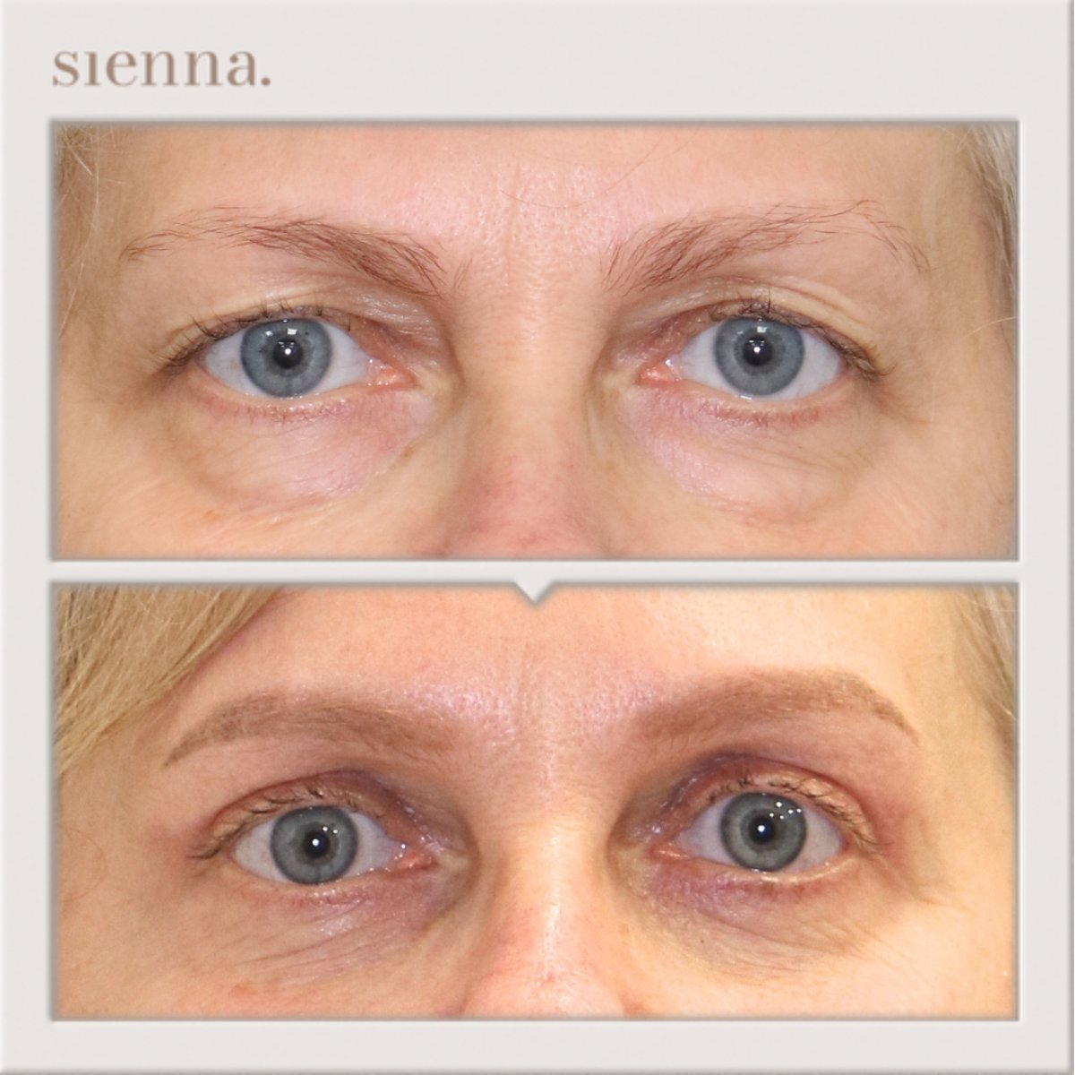 Before and after blepharoplasty results at Sienna Clinic – eyelid correction and rejuvenation