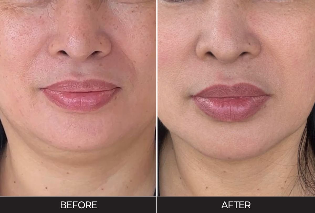 Before and after stem cell rejuvenation therapy result at Forena Clinic for facial anti-aging