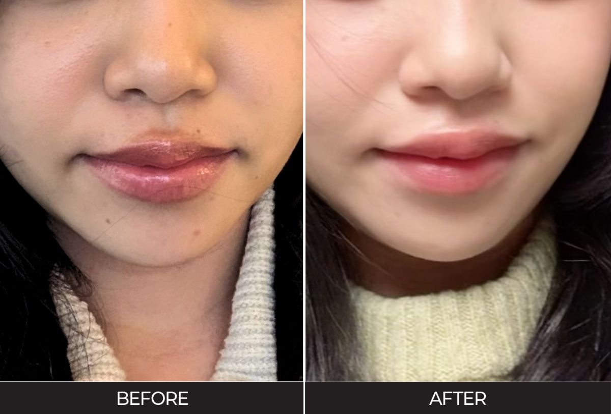 Before and after skin rejuvenation at Forena Clinic – smoother, clearer facial skin results