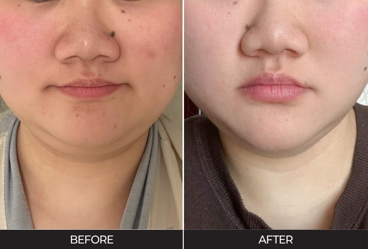 Before and after jaw shaping results at Forena Clinic – improved facial contour and symmetry
