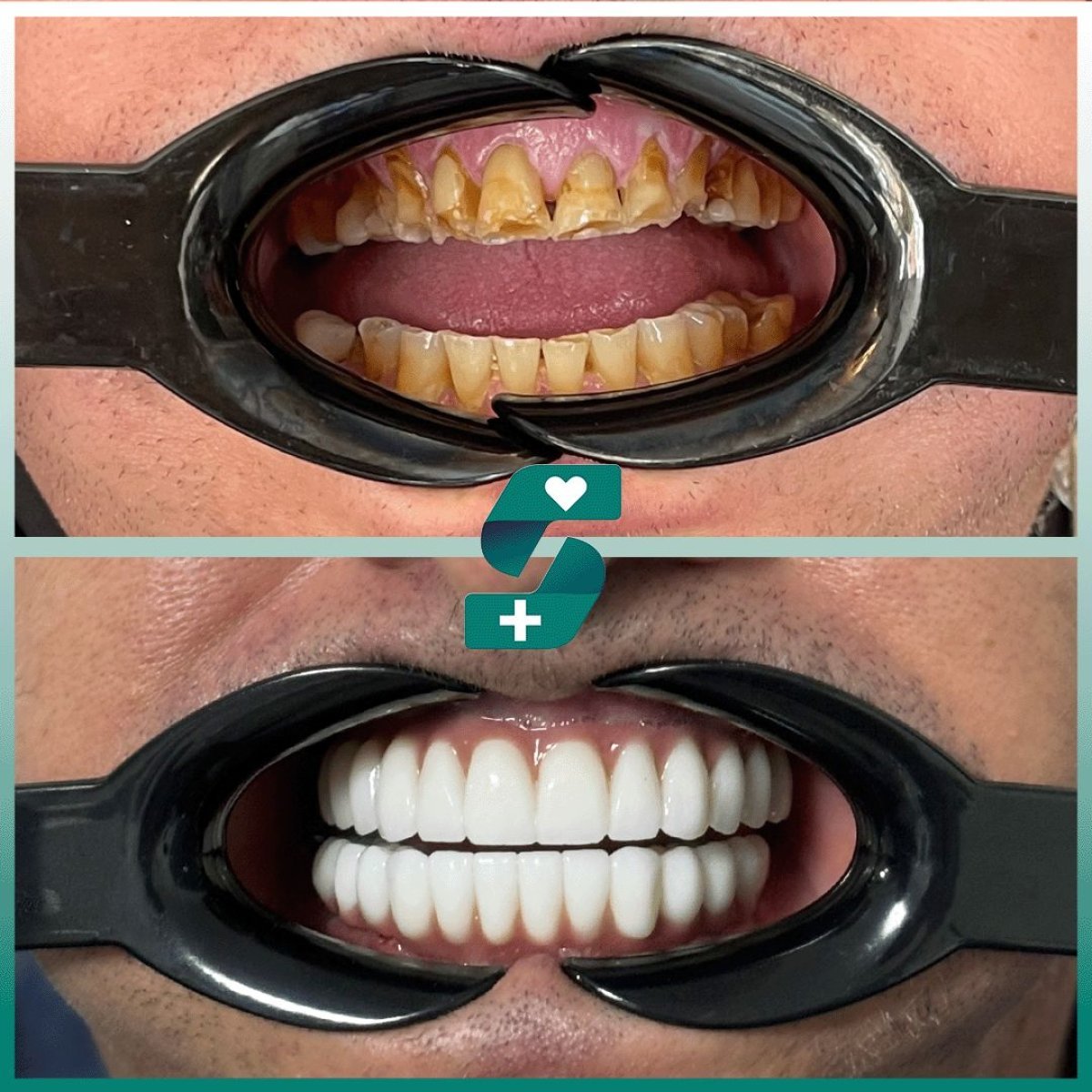 Before and after All-on-6 dental implants result at Soraca Med – full smile restoration