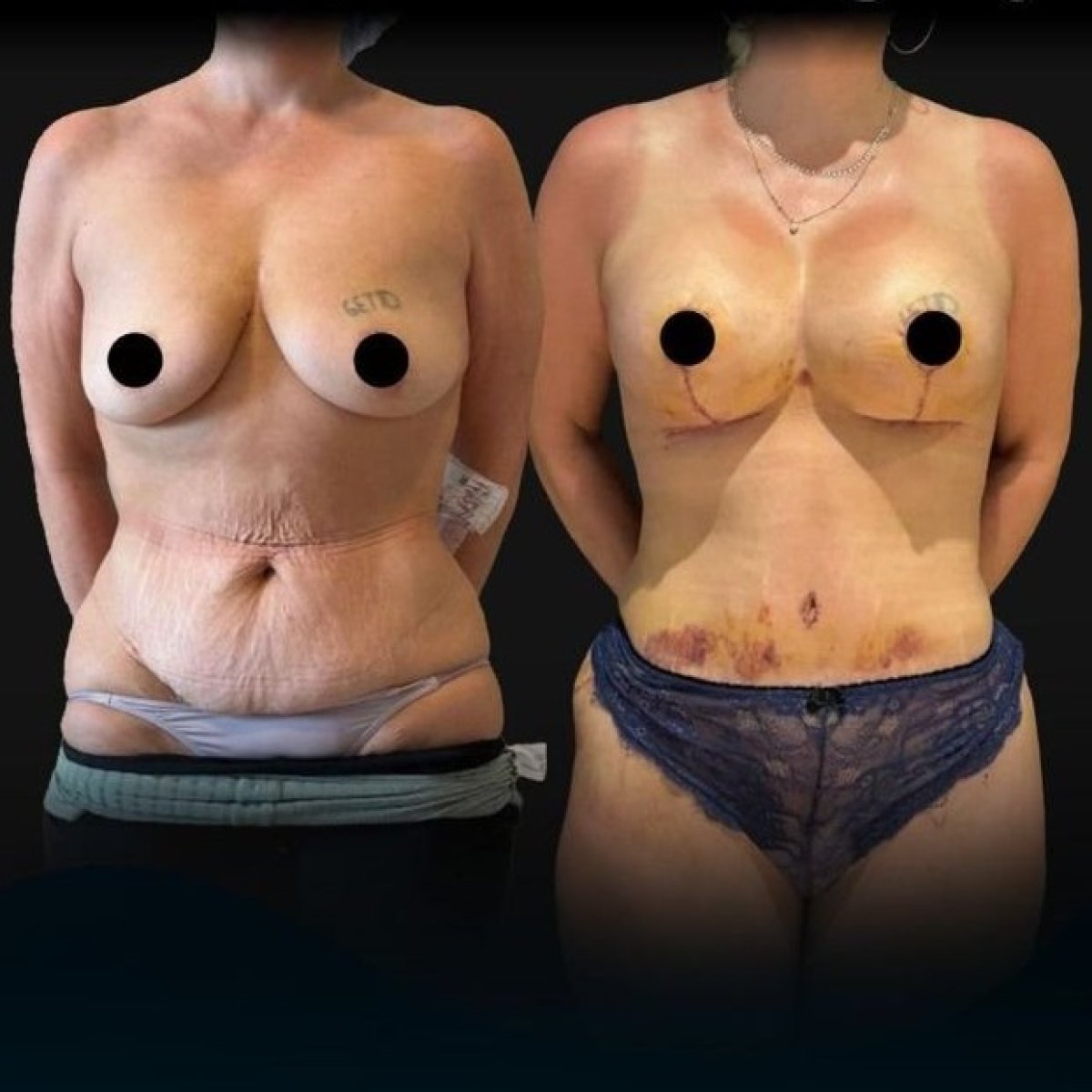 Antes y después de mommy makeover en Soraca Med – resultado visible de contorno corporal