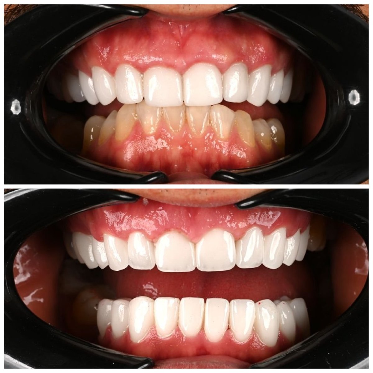 Resultados antes y después de implantes dentales en Soraca Med: sonrisa mejorada y dientes blancos