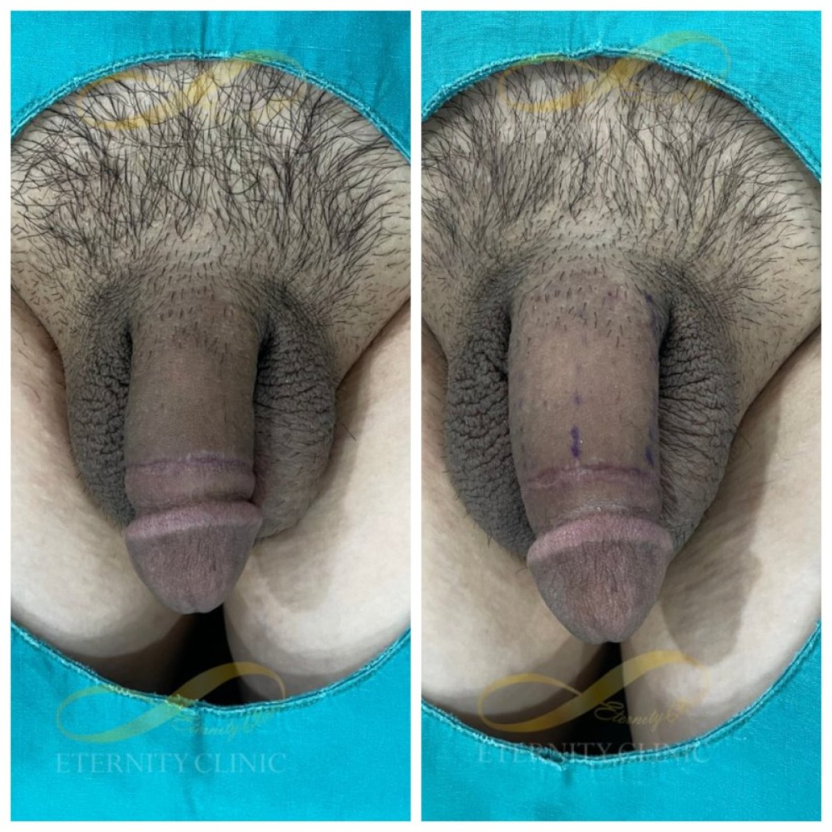 Before and after penis filler results at Eternity Clinic Pleonchit, visible girth enhancement