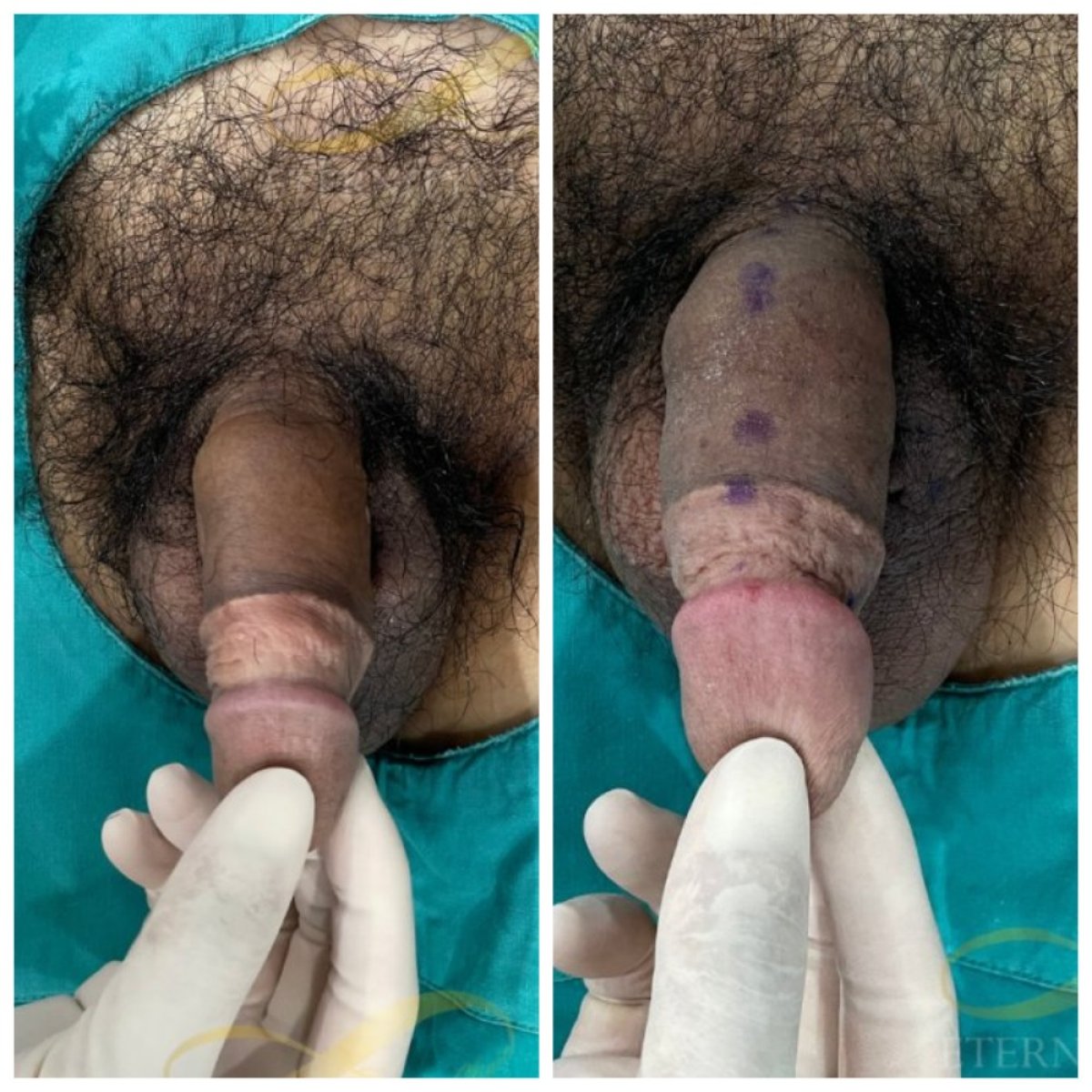 نتائج قبل وبعد حقن الفيلر للعضو الذكري في Eternity Clinic Phuket By Dr.Beer، تحسن واضح