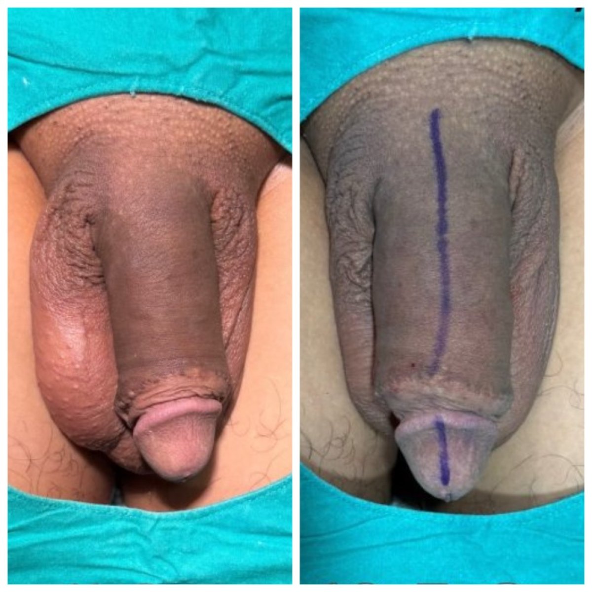 نتائج قبل وبعد حقن الفيلر للعضو الذكري في Eternity Clinic Phuket By Dr.Beer، تحسين ملحوظ