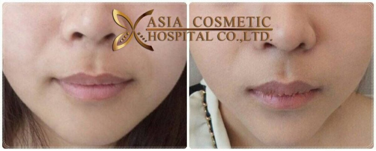 Before and after chin implant results at Asia Cosmetic Hospital, enhanced chin contour visible