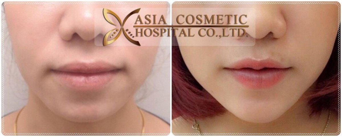 Before and after chin implant results at Asia Cosmetic Hospital, enhanced chin contour visible