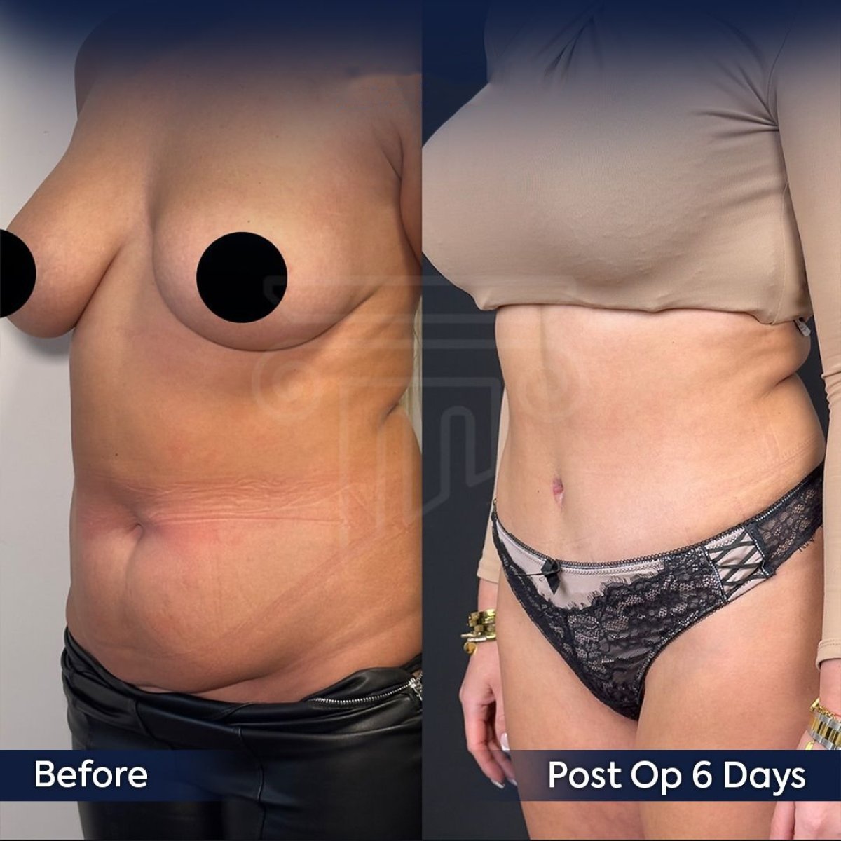 Resultados de abdominoplastia y liposucción antes y después en Dr. Safa Manav Clinic, abdomen plano