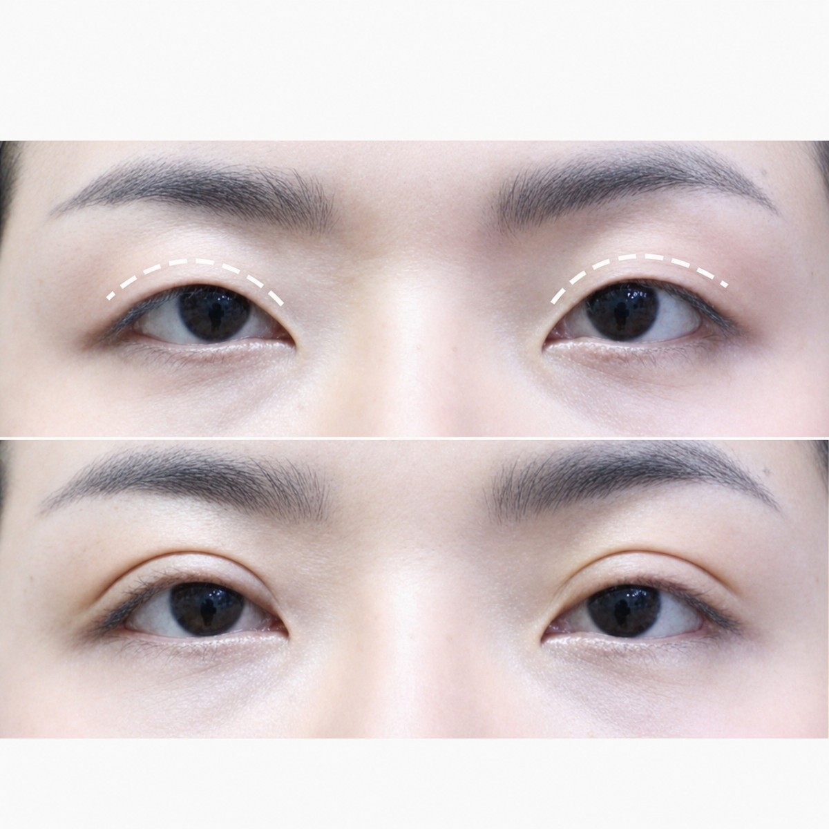 Upper eyelid surgery before and after results at Asia Cosmetic Hospital, improved eye contour