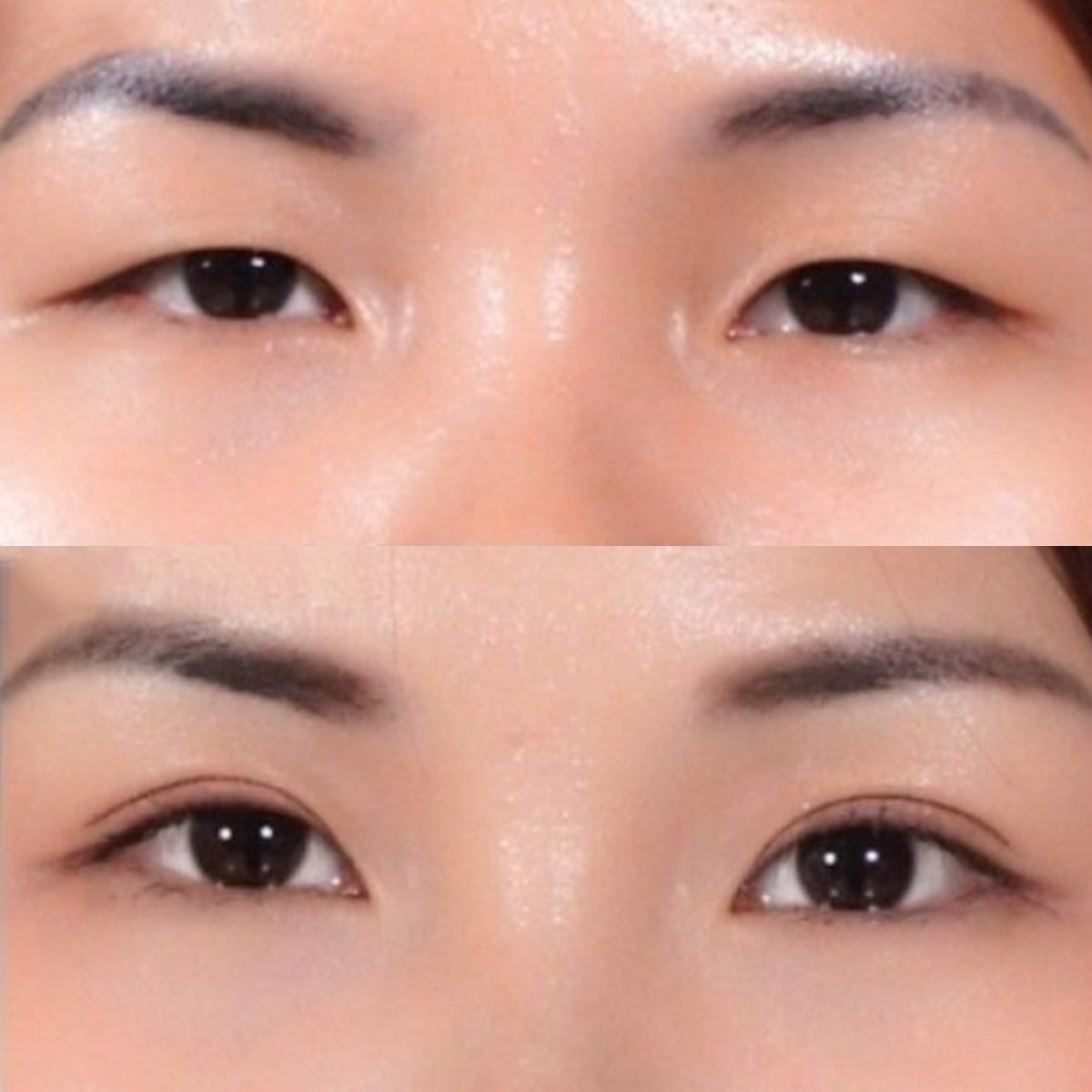 Resultados de blefaroplastia superior antes y después en Asia Cosmetic Hospital, contorno mejorado