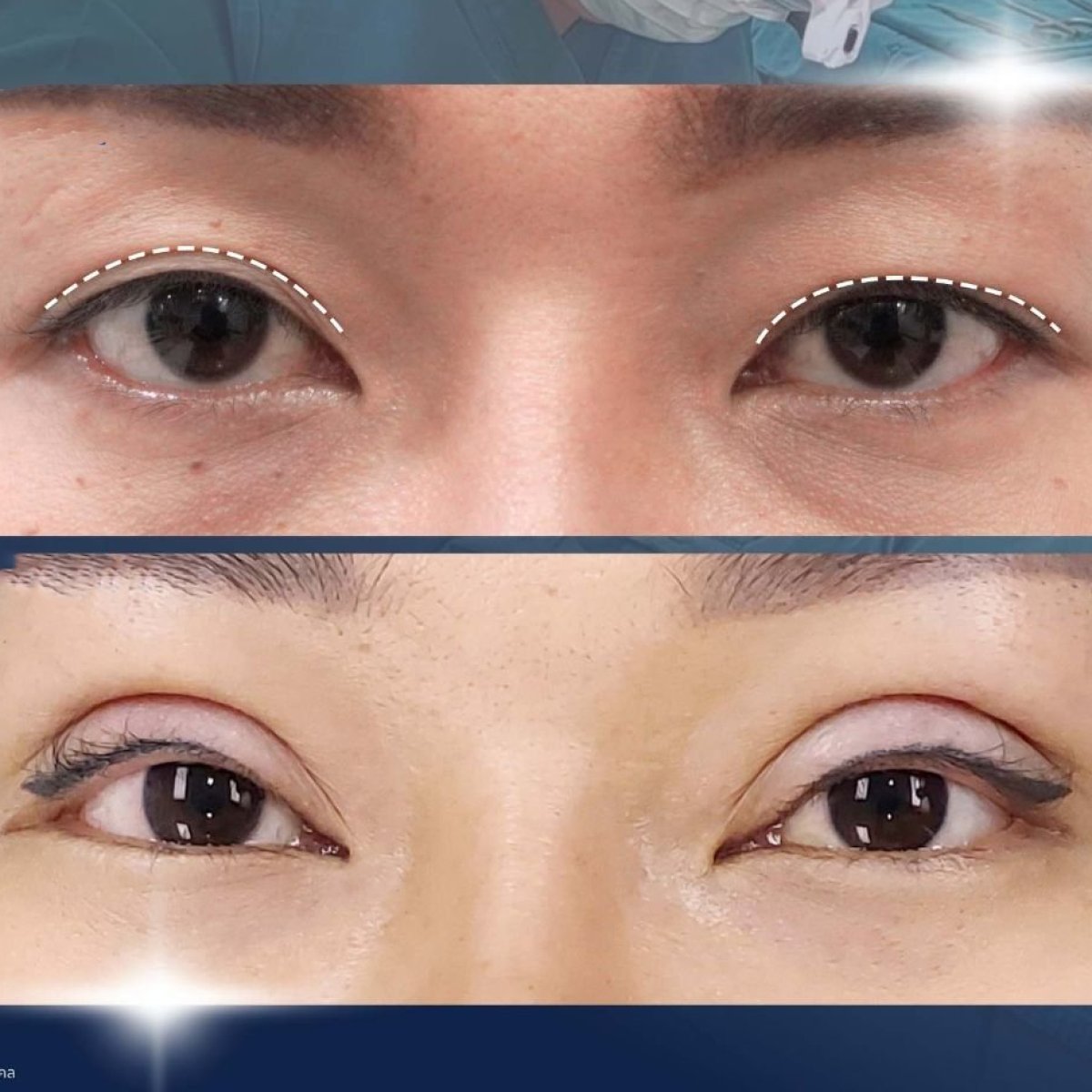 Before and after upper eyelid surgery results at Asia Cosmetic Hospital, improved eyelid contour