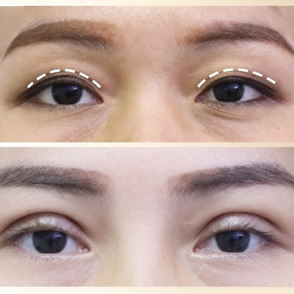 Before and after upper eyelid surgery results at Asia Cosmetic Hospital, eyelid lift improvement