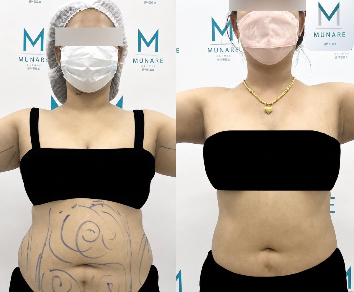 Antes y después de liposucción en Munare Clinic: resultados visibles en el abdomen
