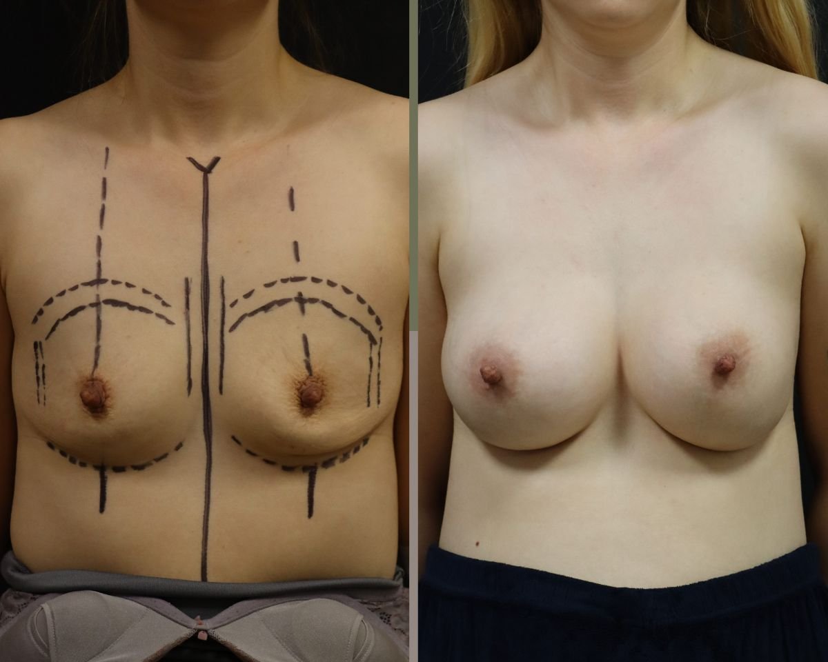 Before and after breast augmentation results at Memorial Ataşehir Hospital, enhanced breast shape