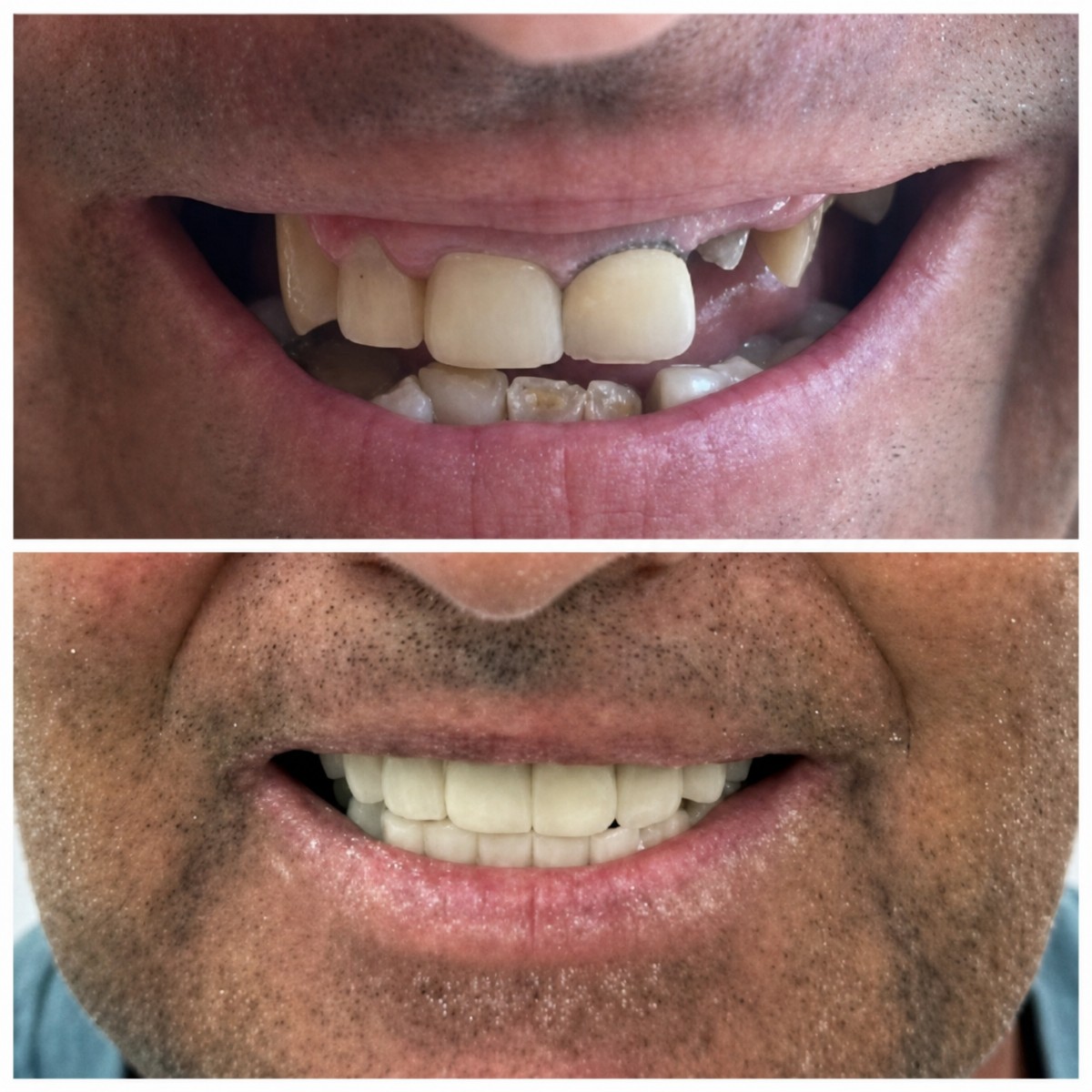نتائج زراعة الأسنان قبل وبعد في Santa Caterina Clinic – ابتسامة مستعادة