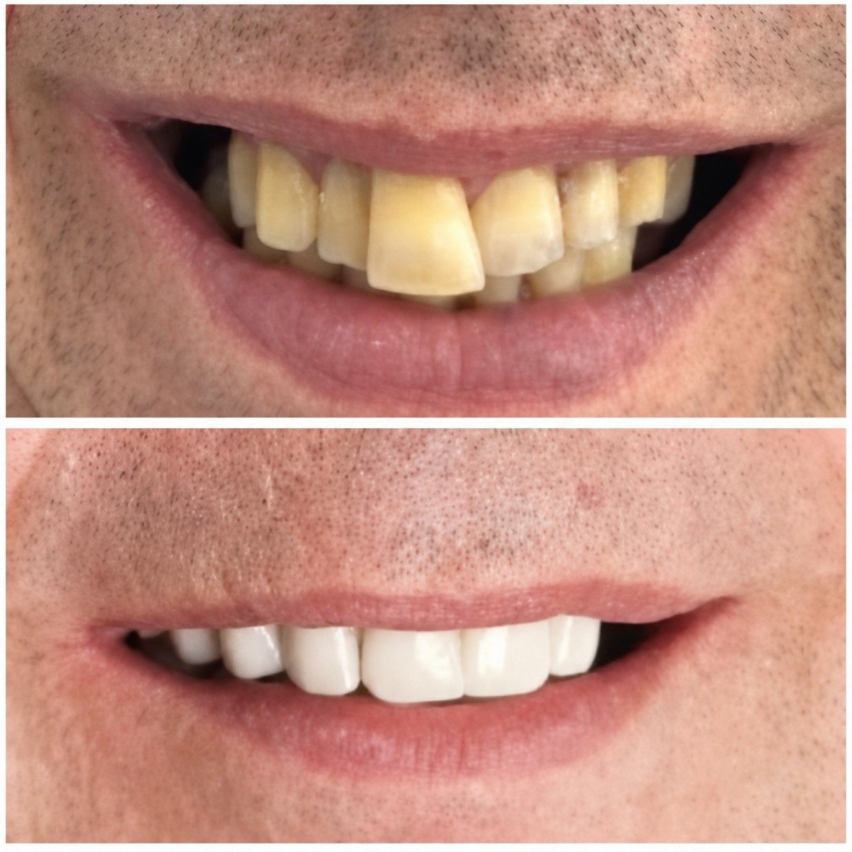 Resultados de implantes dentales antes y después en Santa Caterina Clinic – sonrisa restaurada
