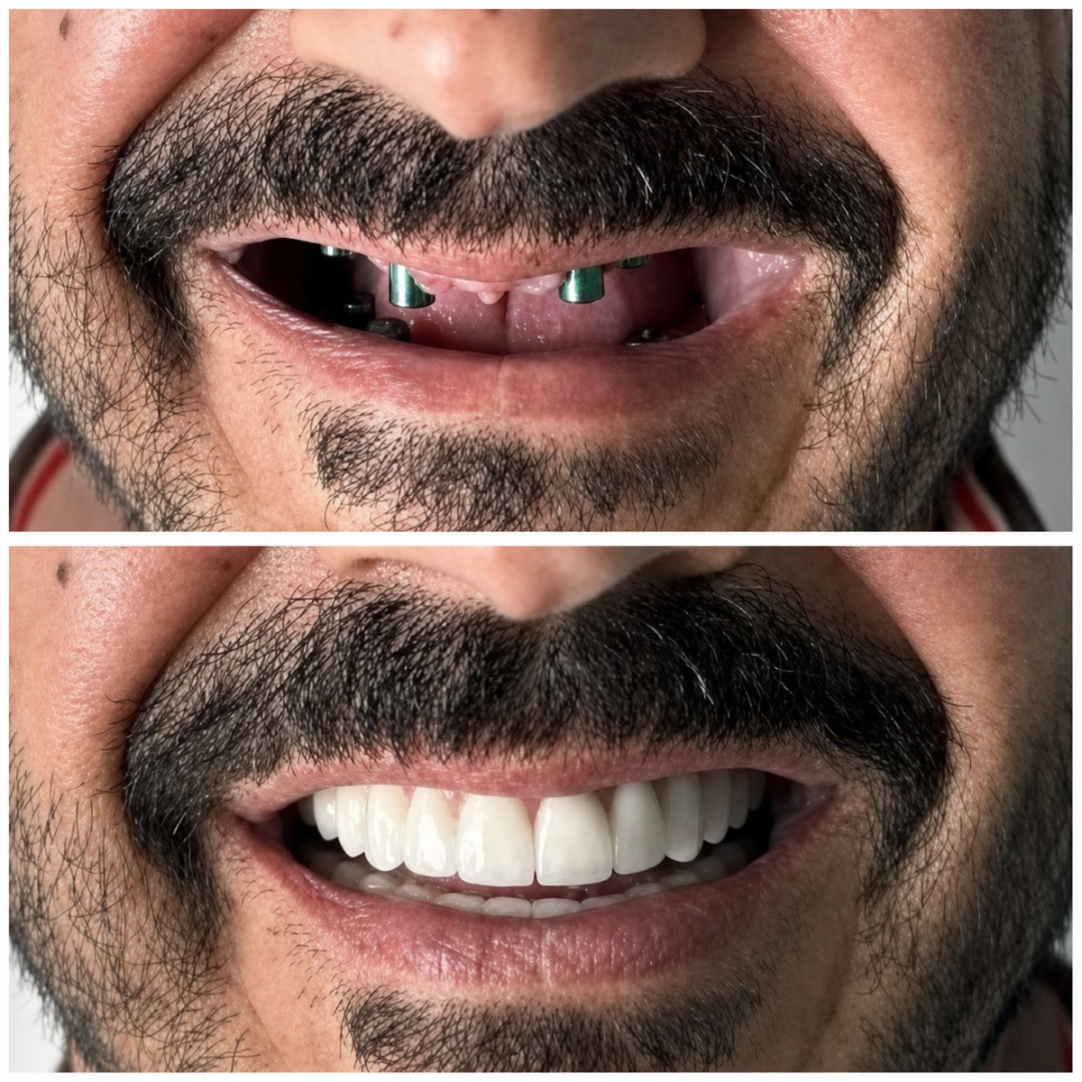 Before and after dental implant results at Santa Caterina Clinic, restored smile transformation