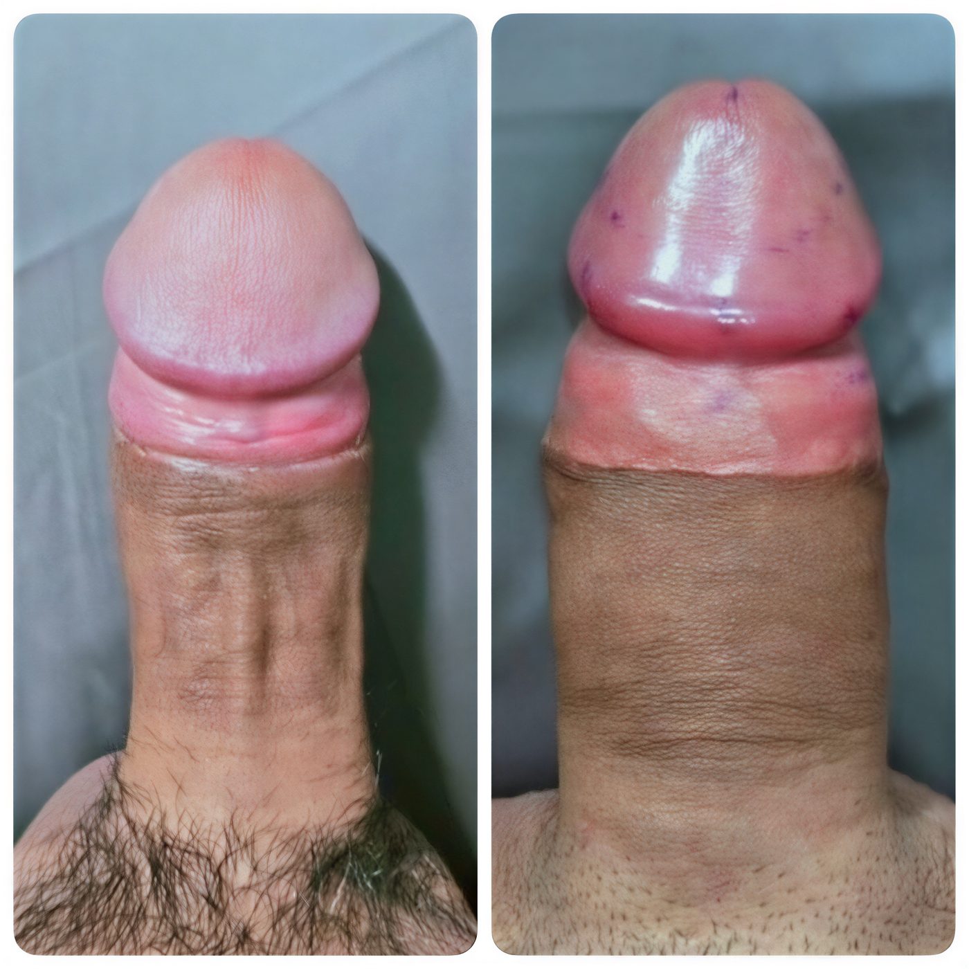 Resultados antes y después de relleno de pene en Eternity Clinic Pleonchit, mayor grosor visible