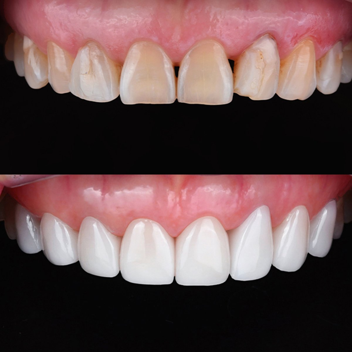 نتائج قبل وبعد عدسات الأسنان الخزفية في 365SeoulOneTop365 Dental Clinic، تجميل الابتسامة
