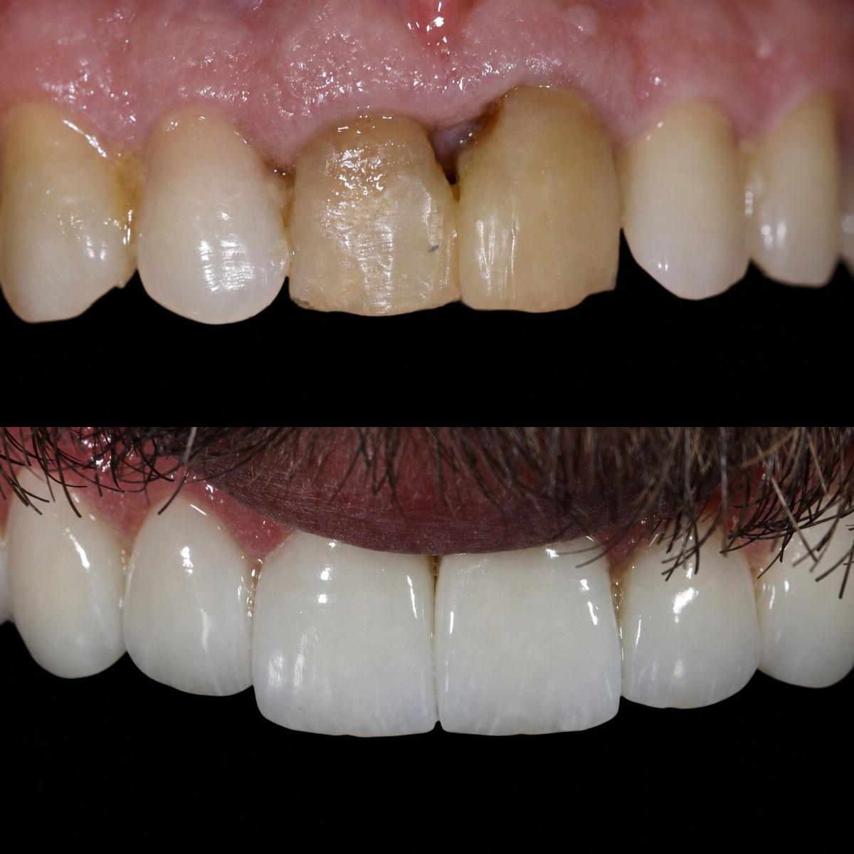 Результаты до и после установки циркониевых коронок в Grand Dental Hospital & Laboratory