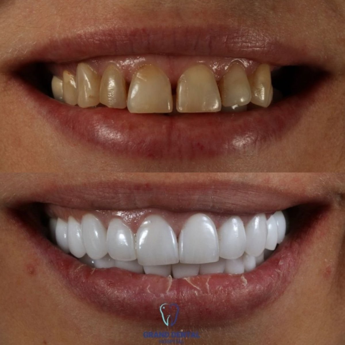نتائج قبل وبعد تركيب تيجان الزركونيا في Grand Dental Hospital & Laboratory، تجميل الابتسامة
