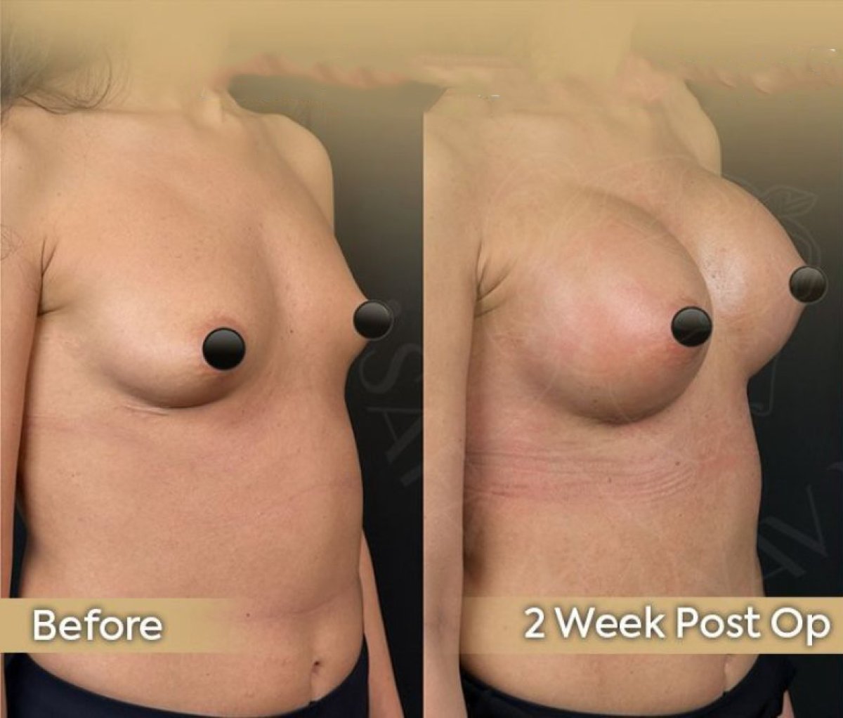 Résultats avant/après implants mammaires avec lifting à la clinique Dr. Safa Manav, 2 semaines