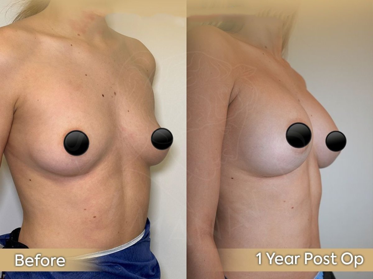 Resultados antes y después de implantes y lifting de senos en Dr. Safa Manav Clinic, 1 año