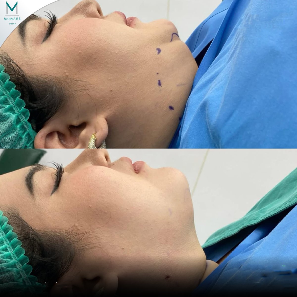 Antes y después de liposucción en Munare Clinic: mejora del contorno de mentón y mandíbula