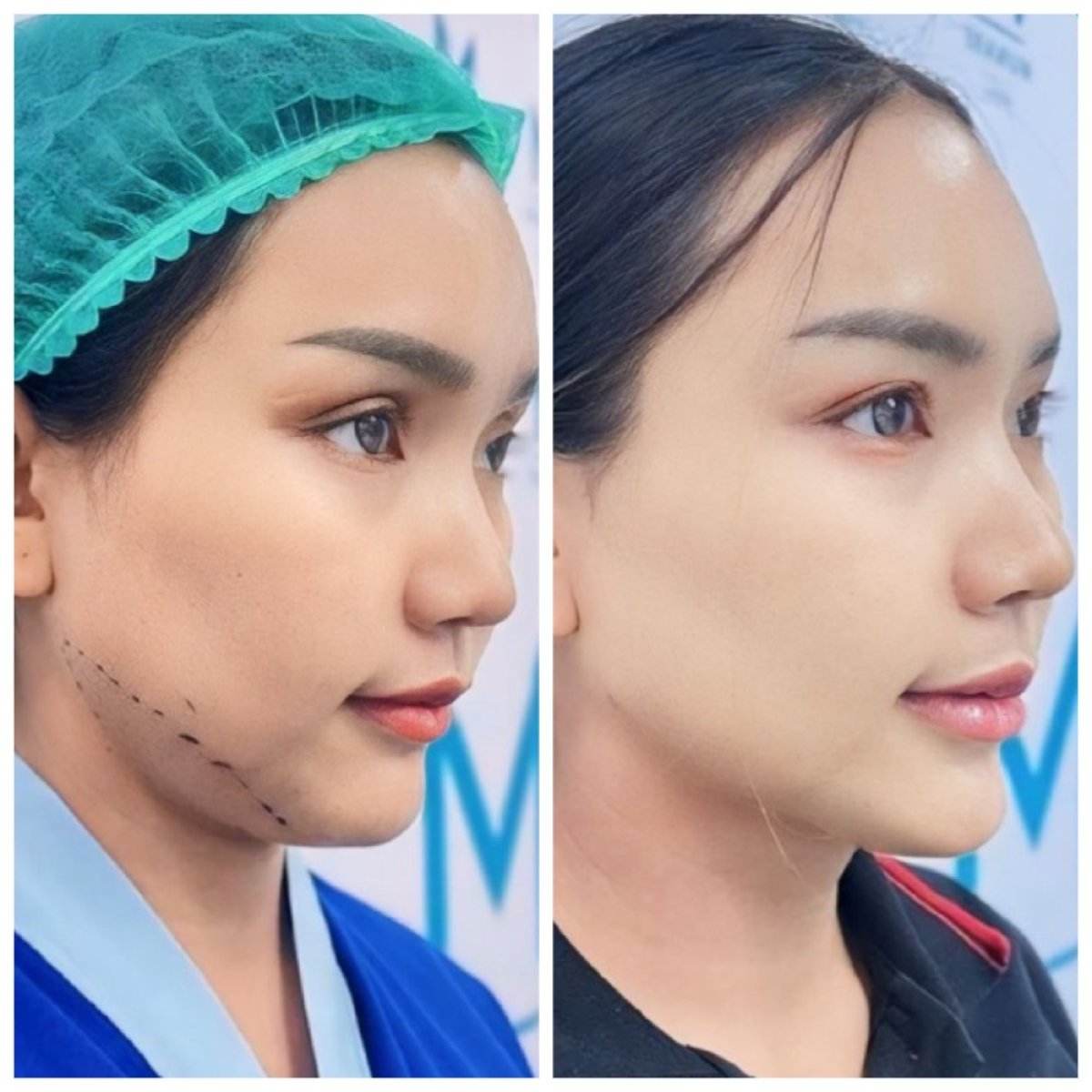 Antes y después de liposucción en Munare Clinic, resultado visible en el contorno mandibular