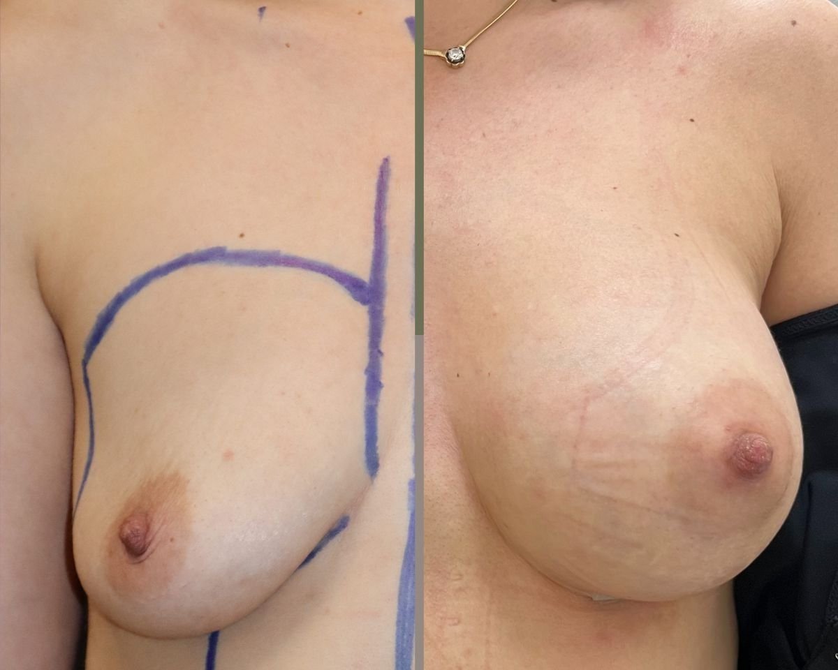 Before and after breast augmentation results at Memorial Ataşehir Hospital, enhanced breast shape