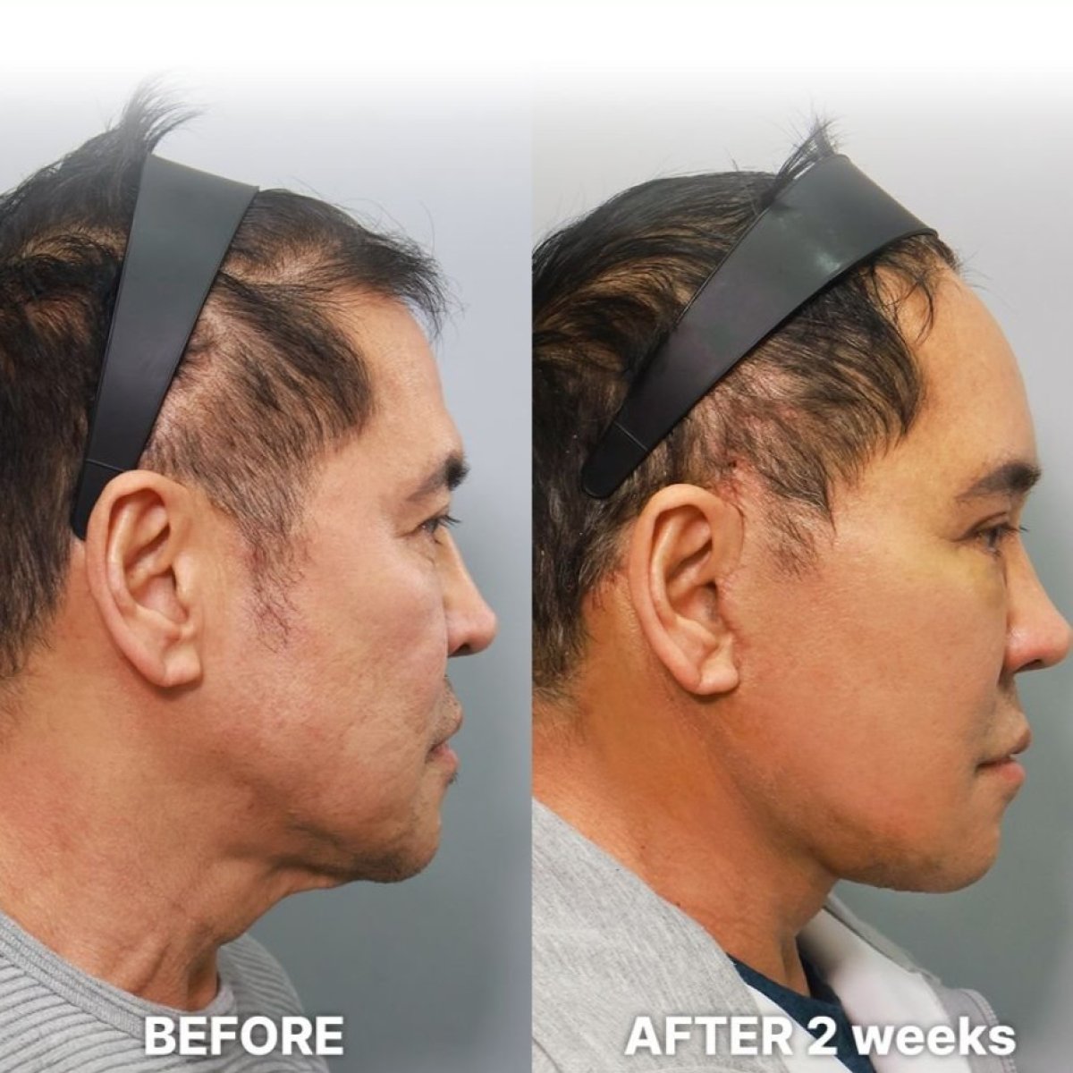 Результаты мини-подтяжки лица до и после в Returning Plastic Surgery, омоложение лица