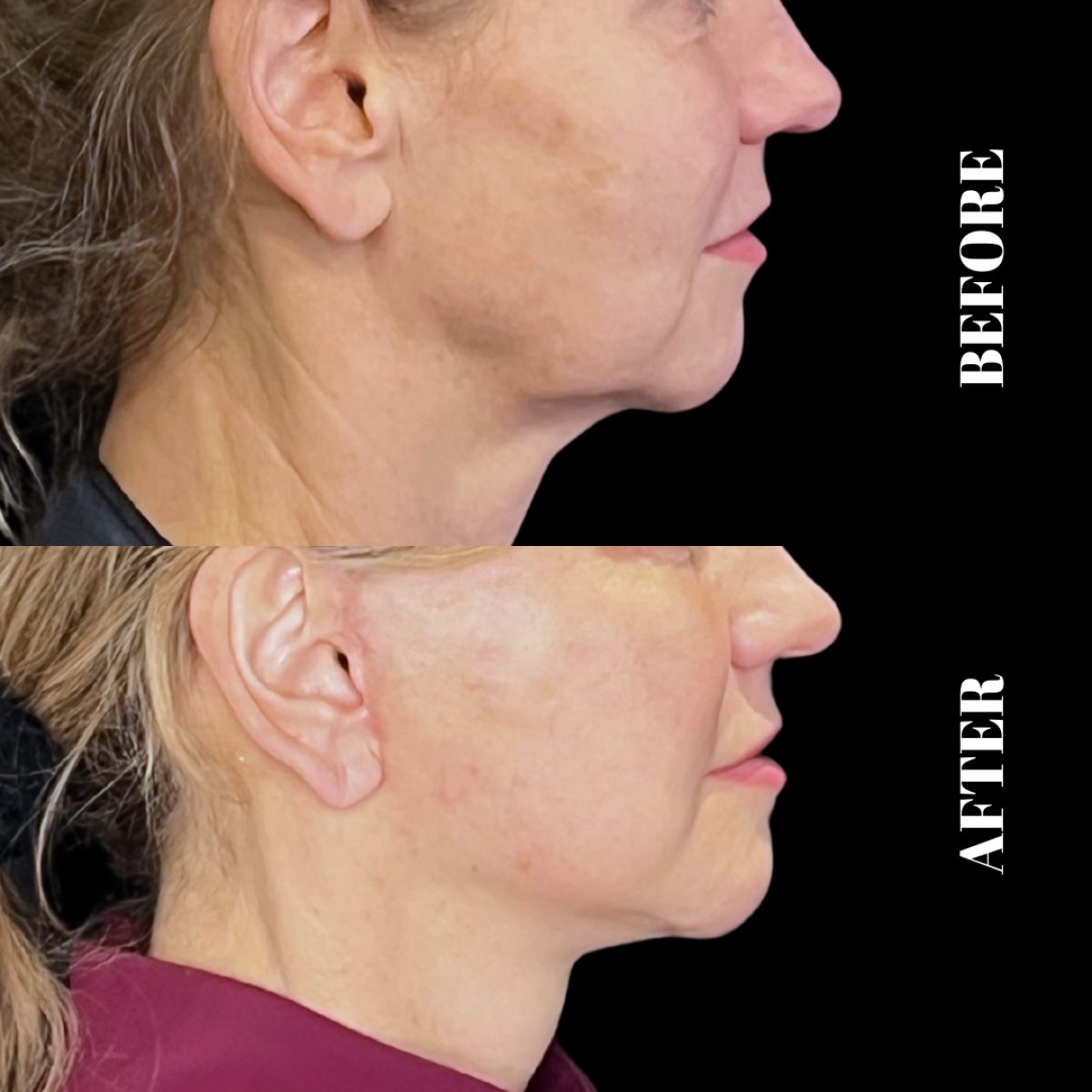 Resultados antes y después de deep plane facelift en Artisan Clinic, lifting visible de cuello y mandíbula